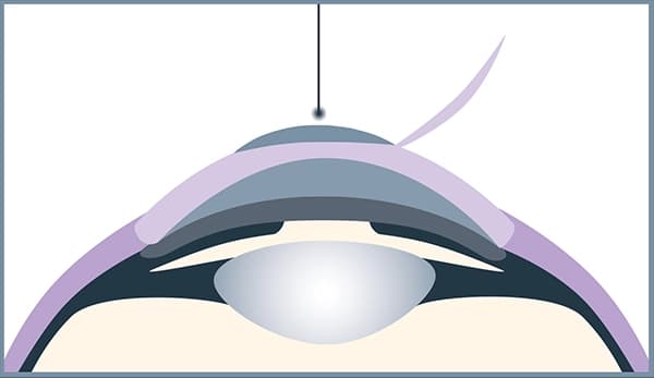 Augen lasern bei YOUSEE: Die Femto-LASIK ist das Verfahren, das weltweit am häufigsten zum Einsatz kommt.