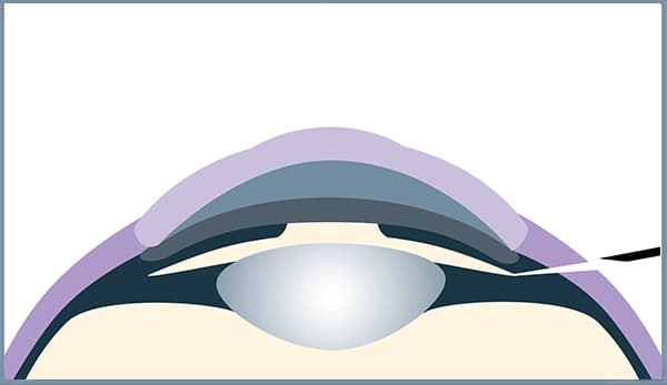 ICL bei YOUSEE: In diesem OP Schritt wird sorgsam durch eine winzige Öffnung die Kontaktlinse in das Auge geschoben.