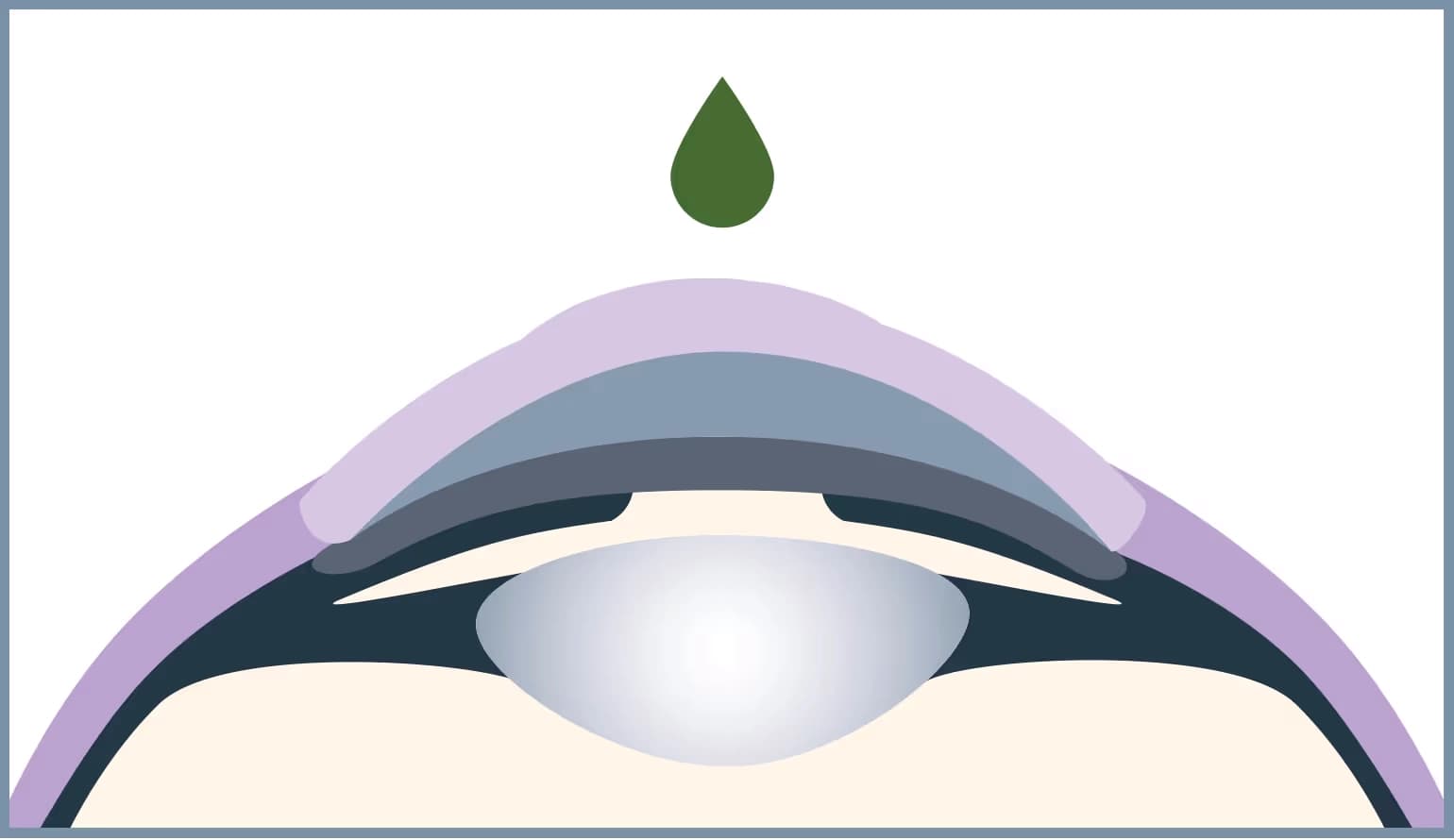 For a painless operation, the eye is first anesthetized with drops and disinfected.