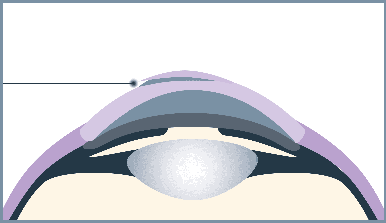 Im zweiten Operationsschritt wird der Flap erstellt.