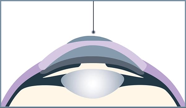 Der Excimer Laser entfernt schmerzfrei die oberste Schicht der Hornhaut.