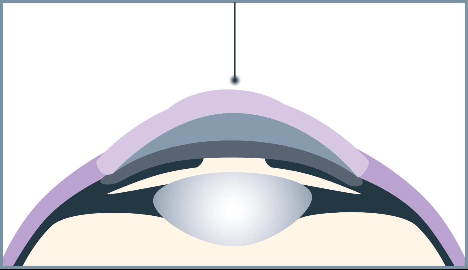 Der Excimer Laser entfernt schmerzfrei die oberste Schicht der Hornhaut.