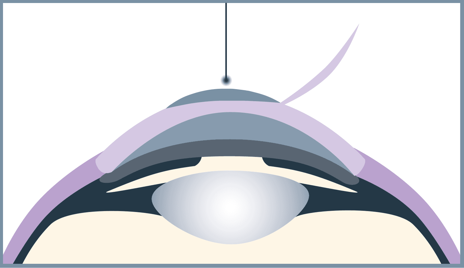 Femto-LASIK is more expensive than Trans-PRK because two lasers are used.