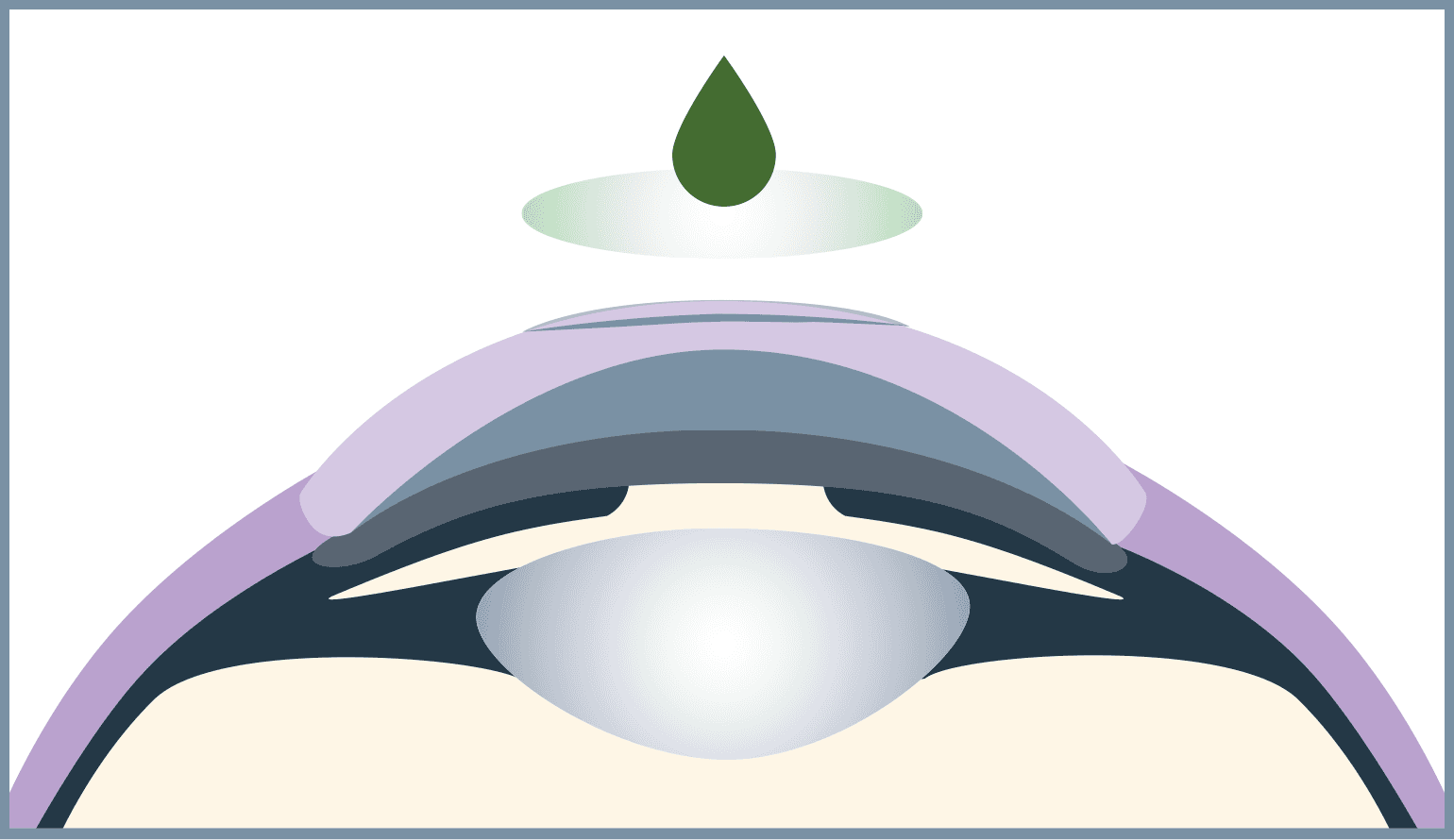 The bandage lens supports the healing process and protects the flap.