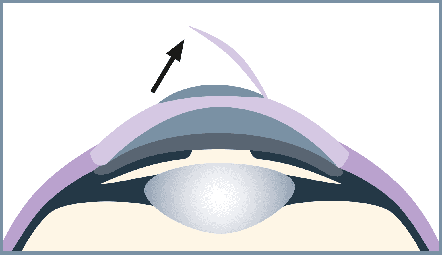 Now the flap is carefully folded back so that the correction can be made in the next step.