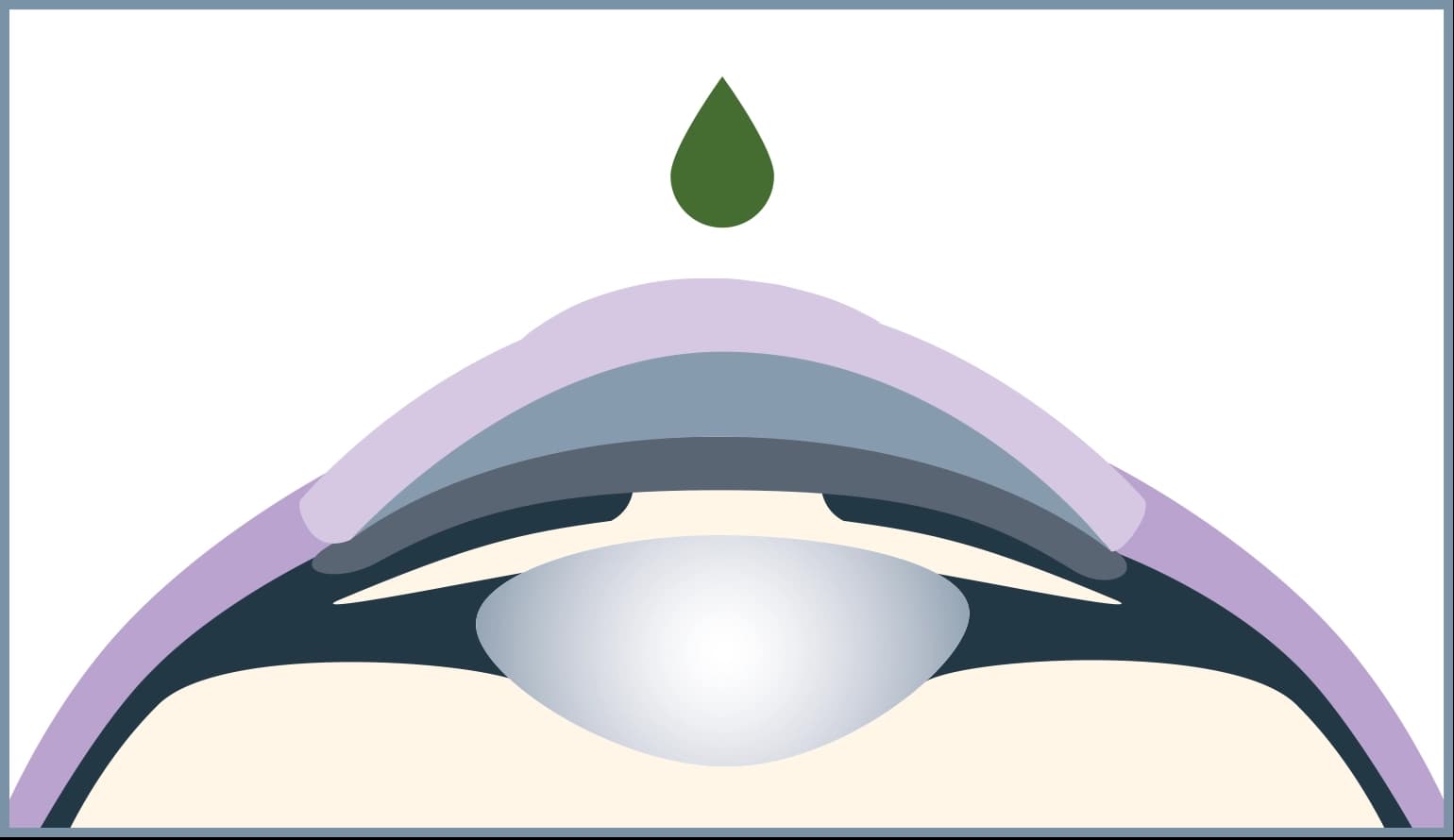 For a painless operation, the eye is first anesthetized with drops and disinfected.