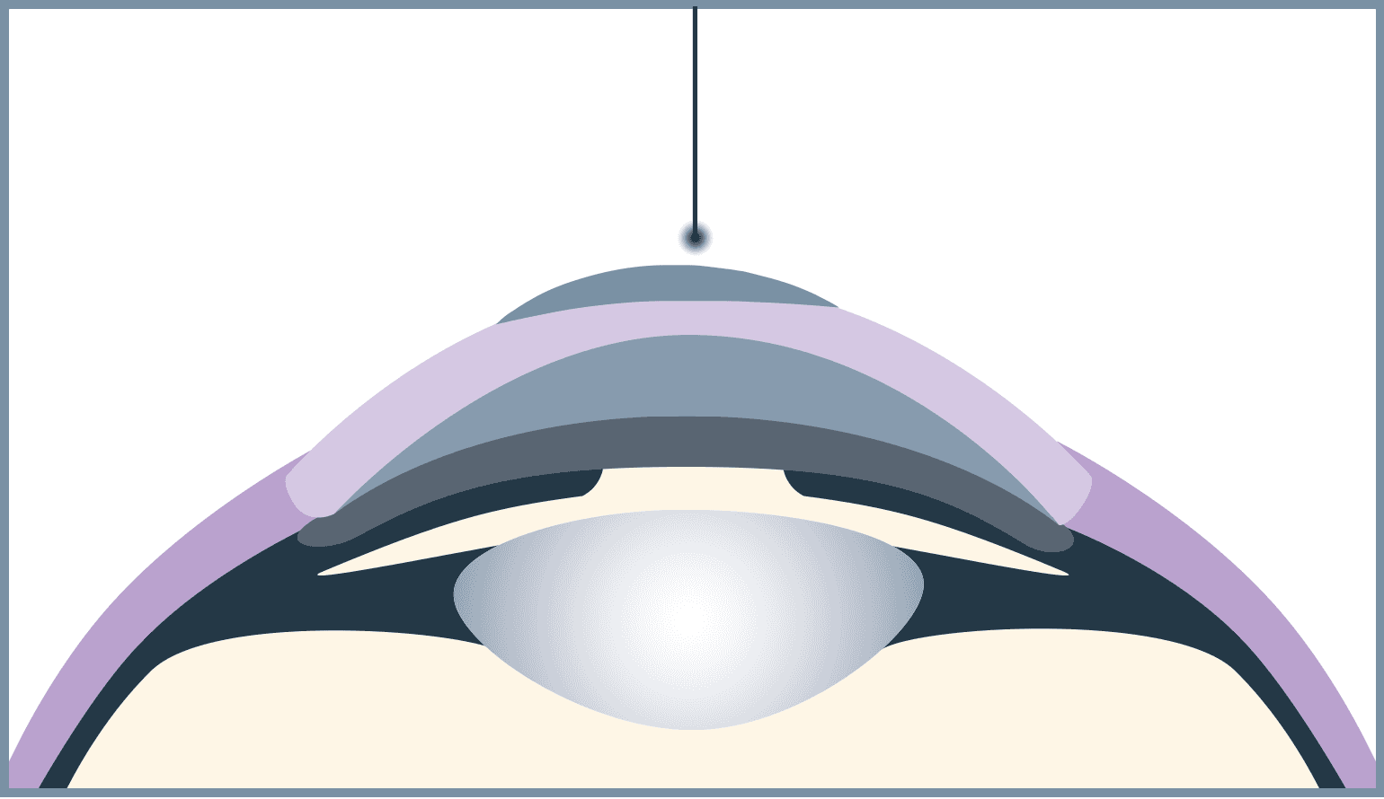 The actual correction is then made on the underlying layer by the Excimer laser.