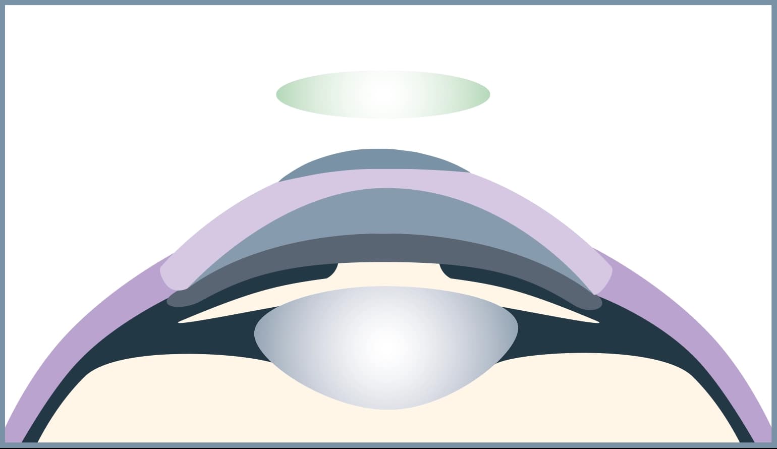 A bandage lens protects the eye and relieves pain.