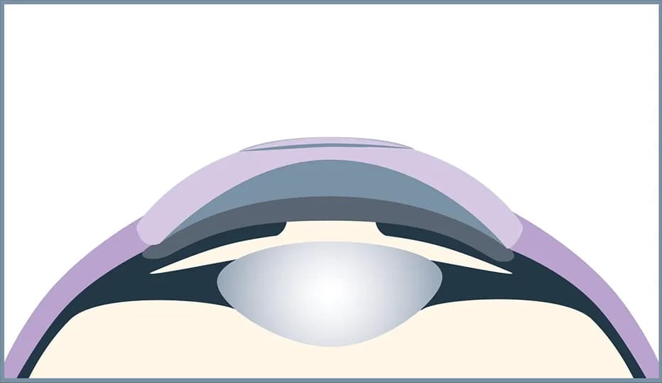 The tiny opening heals on its own; no stitches are necessary.