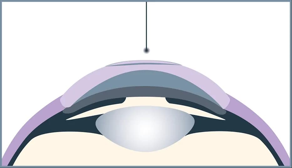 The femto laser creates a minimal incision and the lenticule.