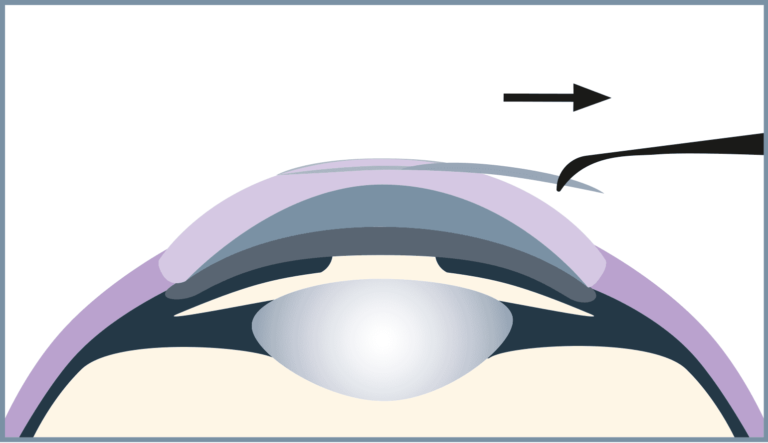 The surgeon removes the lenticule, and the vision correction is complete.