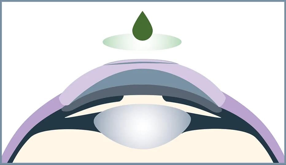 The bandage lens protects the eye and relieves pain.