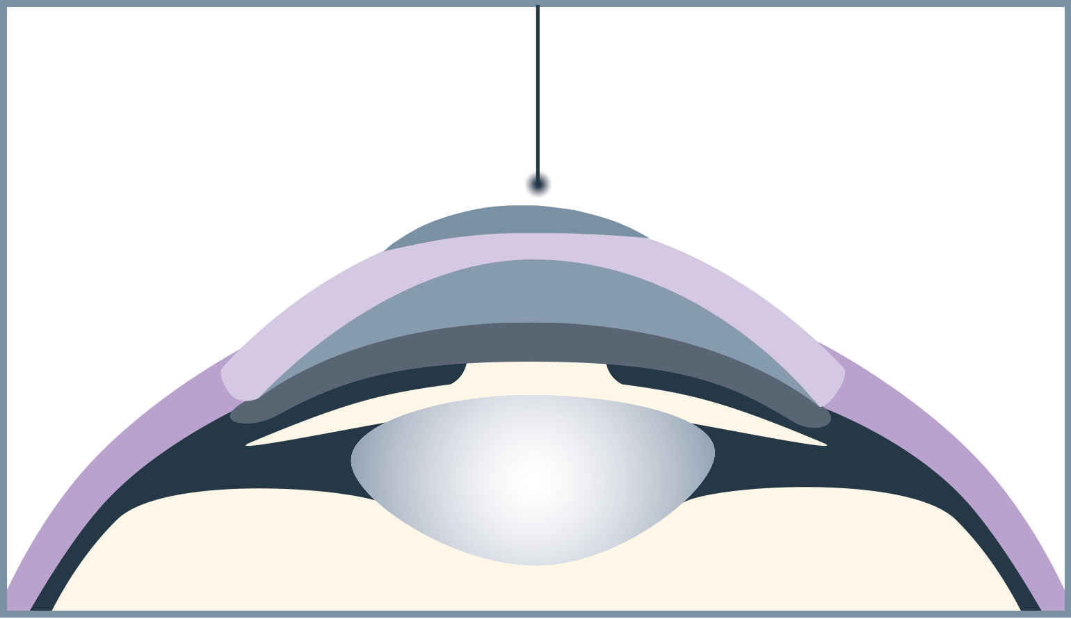 Beim Trans-PRK Verfahren werden Fehlsichtigkeiten von einem Laser präzise in einem einzigen Schritt korrigiert.