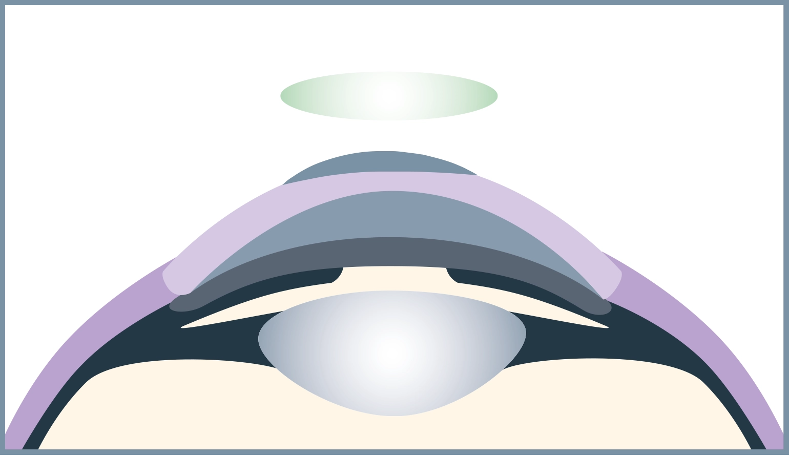 Eine Verbandslinse schützt das Auge und lindert Schmerzen.