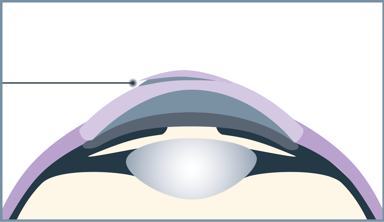 In the second step of the operation, the flap is created.