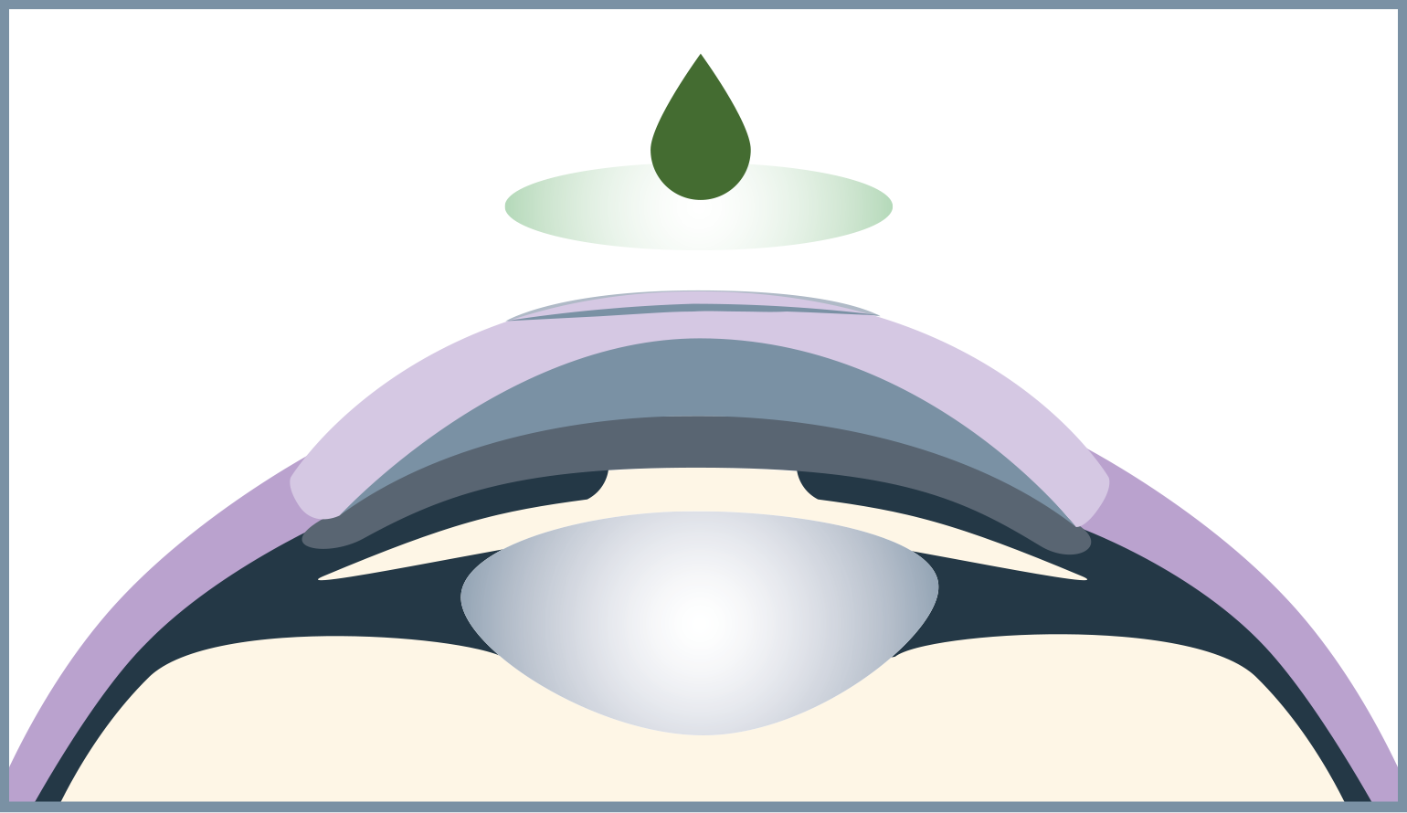 The bandage lens supports the healing process and protects the flap.