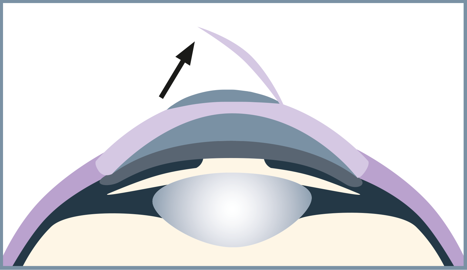 Now the flap is carefully folded back so that the correction can be made in the next step.