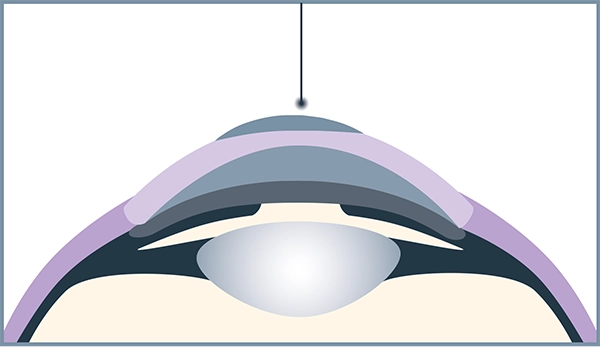In the Trans-PRK procedure, vision problems are precisely corrected by a laser in a single step.