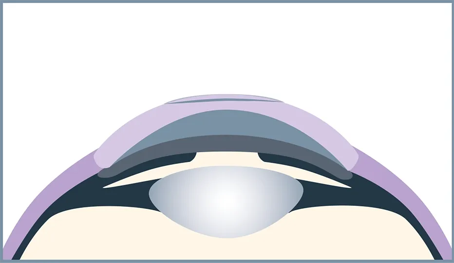 The tiny opening heals on its own; no stitches are necessary.