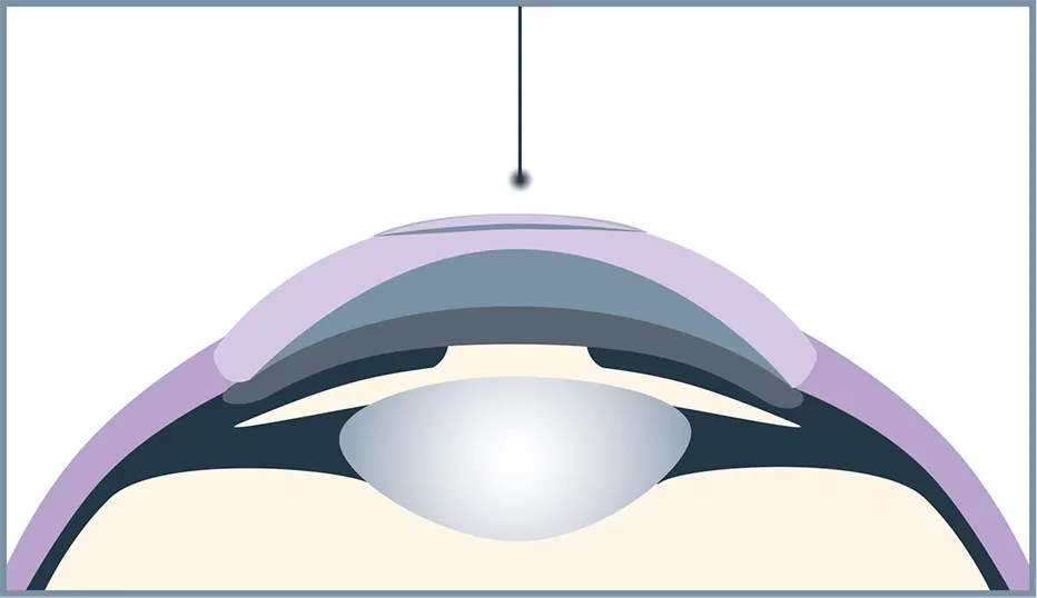 The femto laser creates a minimal incision and the lenticule.
