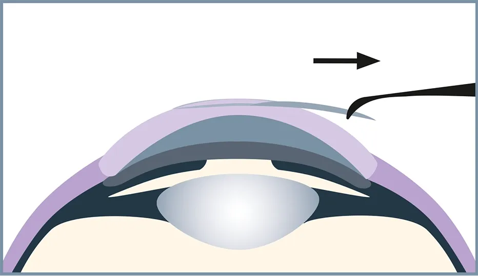 KLEx is the most expensive and complex laser procedure.